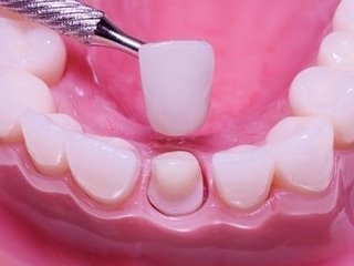 Что выбрать: протезирование зубов или коронку?